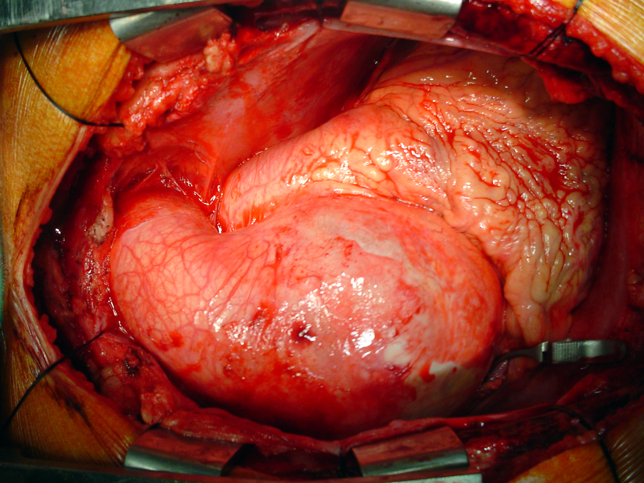 aorta ascendente